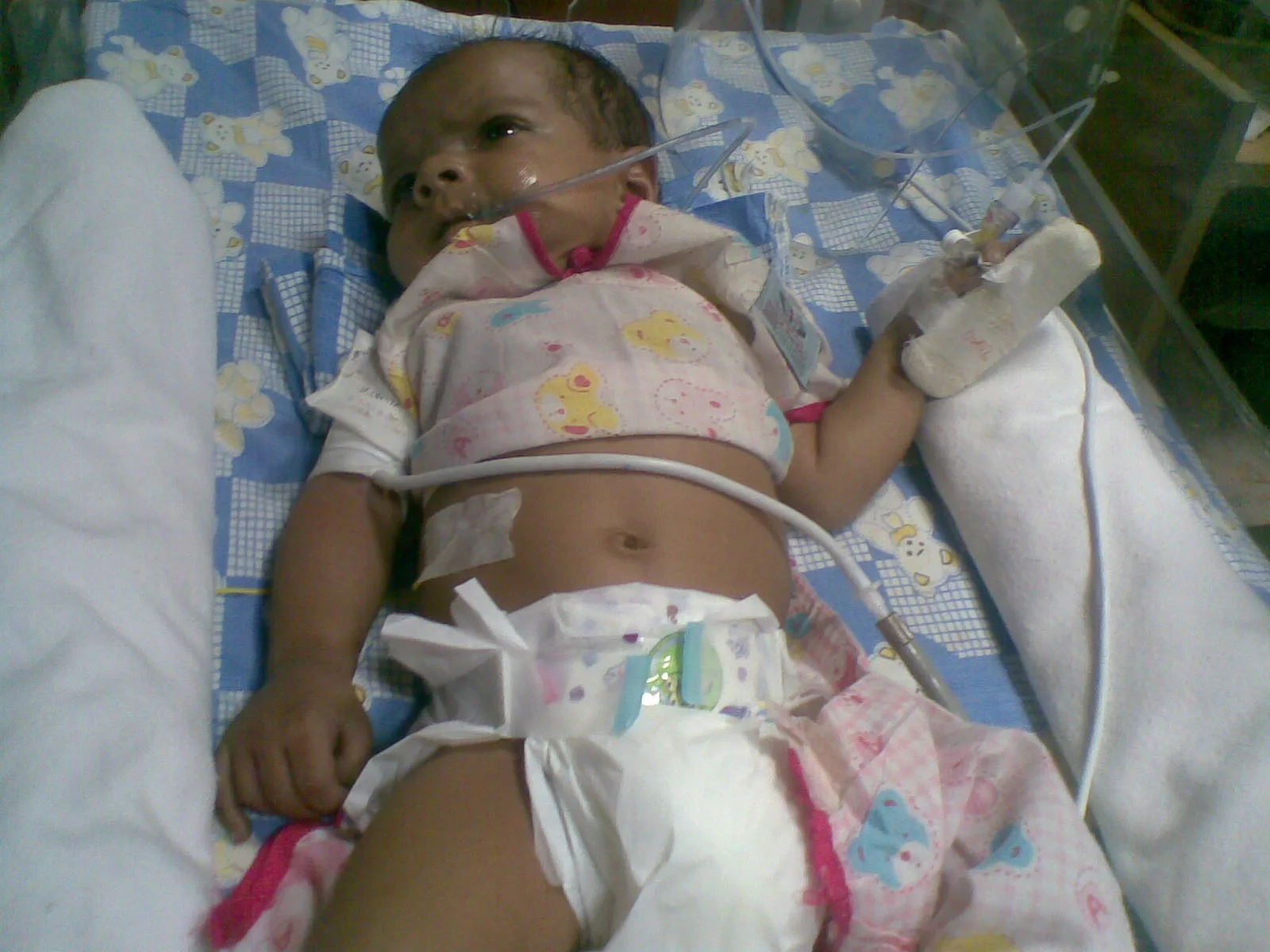 UNUSUAL CASE OF BLUE BABY SYNDROME (METHEMOGLOBINEMIA ) IN A NEONATE DUE TO WATER CONTAMINATION
