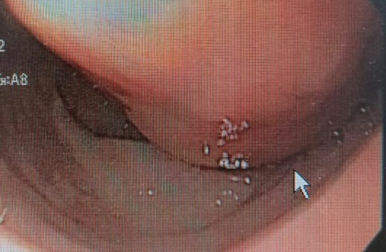 IN AN UNIQUE SURGERY PACEMAKER PUT INSIDE THE BRAIN TO CONTROL PARKINSON’S DISEASE