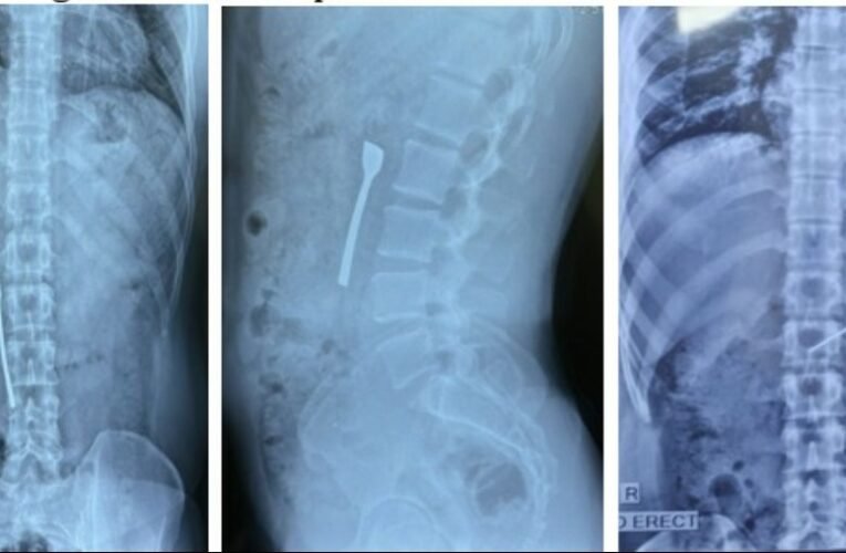8 cms Metallic Spoon successfully removed from 30-Year-Old Male’s Intestine in Rare Emergency Case at Fortis Shalimar Bagh.